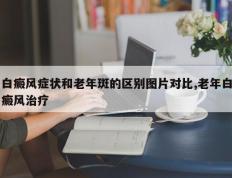 白癜风症状和老年斑的区别图片对比,老年白癜风治疗