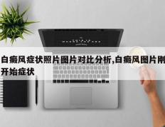 白癜风症状照片图片对比分析,白癜风图片刚开始症状