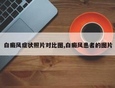 白癜风症状照片对比图,白癜风患者的图片
