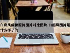 白癜风症状照片图片对比图片,白癜风图片是什么样子的