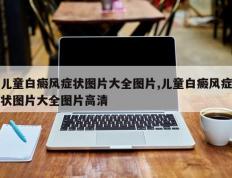 儿童白癜风症状图片大全图片,儿童白癜风症状图片大全图片高清