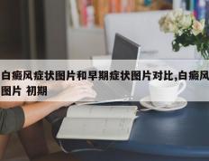 白癜风症状图片和早期症状图片对比,白癜风图片 初期