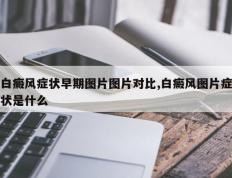 白癜风症状早期图片图片对比,白癜风图片症状是什么