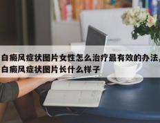 白癜风症状图片女性怎么治疗最有效的办法,白癜风症状图片长什么样子