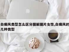 白癜风类型怎么区分图解图片女性,白癜风的几种类型