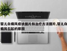婴儿白癜风症状图片和治疗方法图片,婴儿白癜风引起的原因