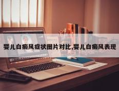 婴儿白癜风症状图片对比,婴儿白癜风表现