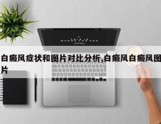 白癜风症状和图片对比分析,白癜风白癜风图片