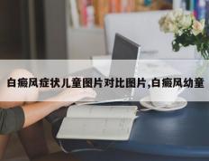 白癜风症状儿童图片对比图片,白癜风幼童