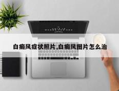白癜风症状照片,白癜风图片怎么治
