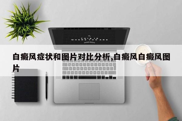 白癜风症状和图片对比分析,白癜风白癜风图片
