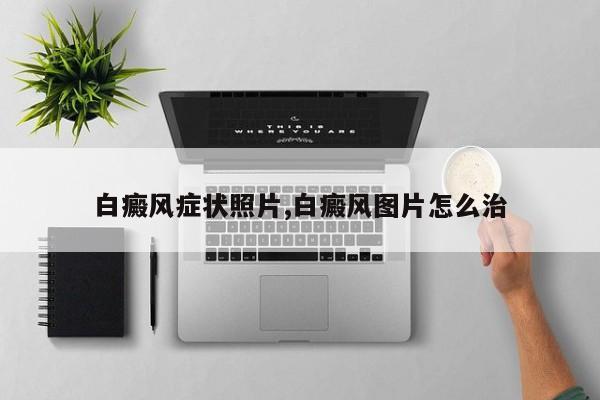 白癜风症状照片,白癜风图片怎么治
